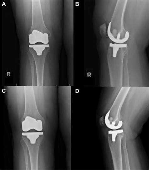 Isolated Polyethylene Insert Exchange for Flexion Instability After Primary Total Knee ...