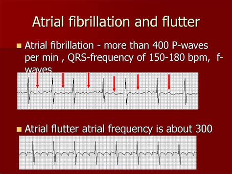 What Is The Treatment For Atrial Flutter