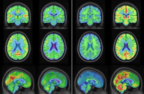 Clinical and Technical Considerations for Brain PET Imaging for ...