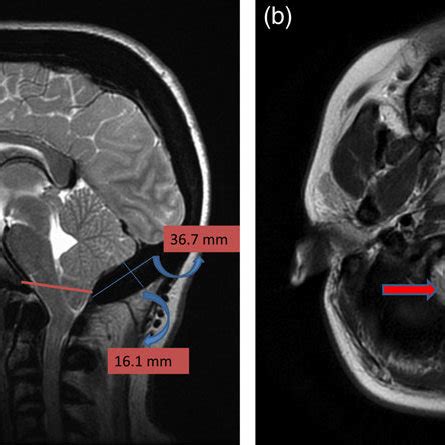 (a) Sagittal T2-weighted image showing cerebellar tonsillar herniation ...