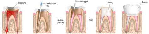 Root Canal Therapy - Greenwich Cosmetic Dentistry