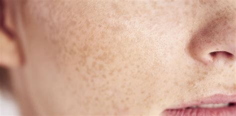 Hyperpigmentation Treatments | Ventura County | Bloom Med Spa