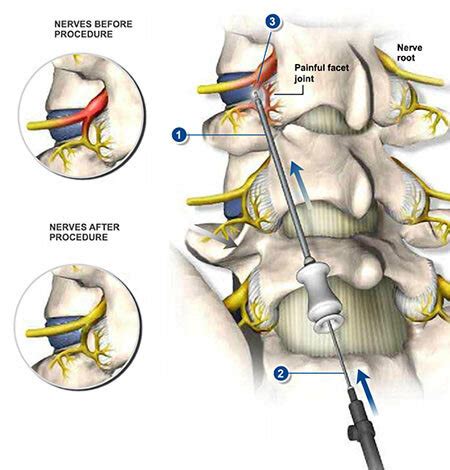 Lumbar Sympathetic Block – iSPINE