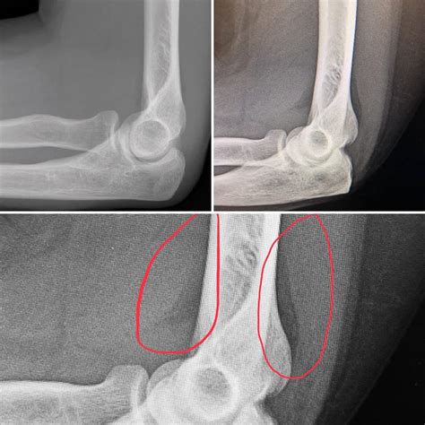 Discovering an Occult Fracture - The Orthopaedic Specialists of Louisville