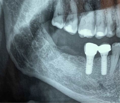 Orthopantomography (OPT) exhibited from the patient during the first ...