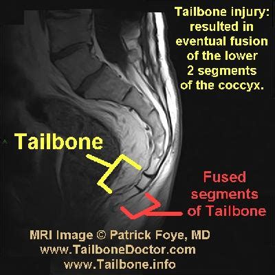 Tailbone Images (for coccyx pain) | Tailbone Doctor