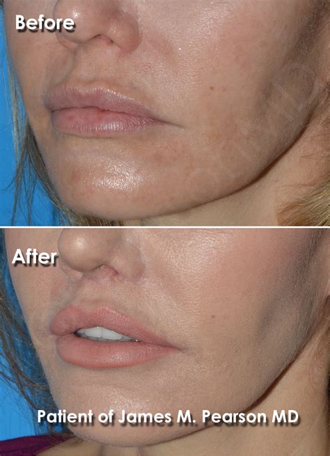 Lip Lift Photos - Before & After - Dr. James Pearson Facial Plastic Surgery