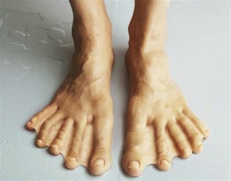 Webbed Toes - Causes, Diagnosis, Surgery and Pictures