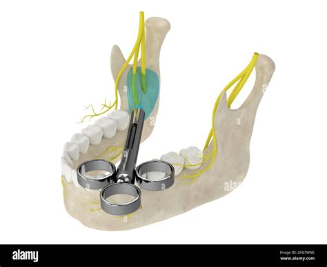 3d render of mandibular arch with inferior alveolar nerve block. Types of dental anesthesia ...