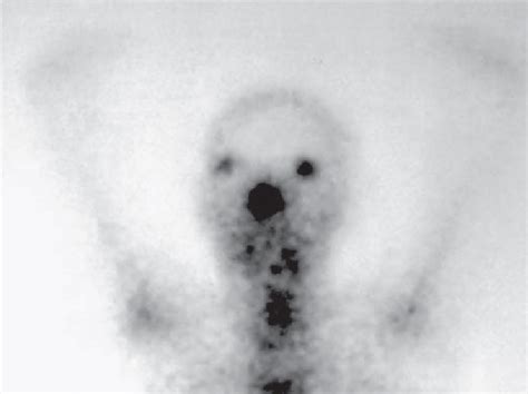 Gallium scan showing focal accumulation of gallium in right hilar ...