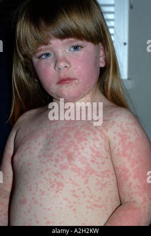 Amoxicillin drug rash on young girl Stock Photo - Alamy