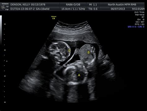 The Texas Trio: A Triplet Pregnancy Blog: 16 week ultrasound pics