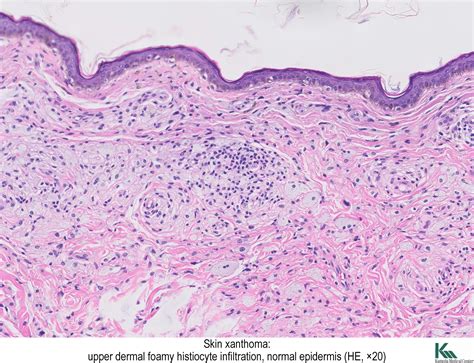 Pathology Outlines - Xanthoma