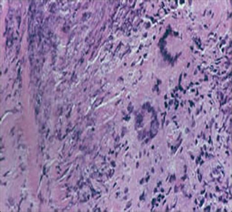 Round 6: A Case of Wegener's Granulomatosis • Arthritis Information