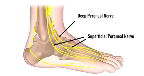 Peroneal Nerve Foot Drop