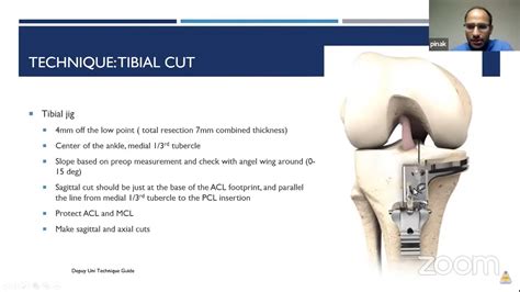 Unicondylar Knee Replacement — OrthopaedicPrinciples.com