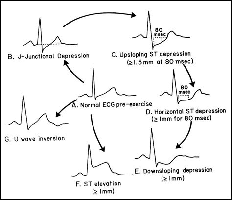 [DIAGRAM] Normal Ekg Diagram - MYDIAGRAM.ONLINE