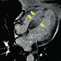 A: transthoracic echocardiography. Interventricular septum with a 32 mm ...