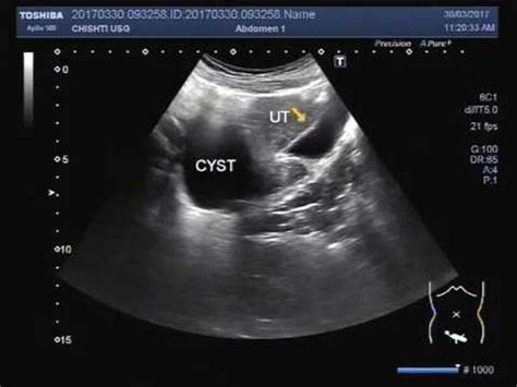 simple (uncomplicated ) RETENSION OVARIAN CYST | Doovi