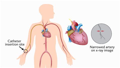 Coronary Angiogram - Cardiovascular Institute of the Shoals