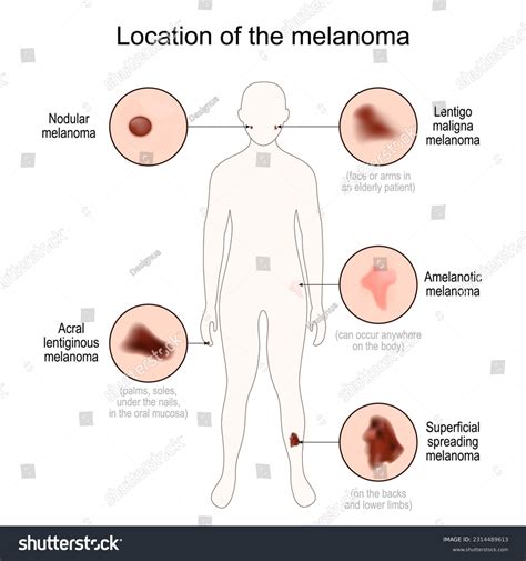 Superficial Spreading Melanoma: Over 5 Royalty-Free Licensable Stock Vectors & Vector Art ...