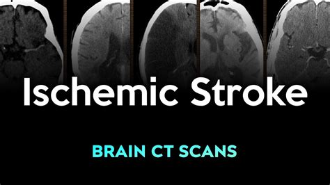 Ischemic Stroke: Brain CT Scans - YouTube