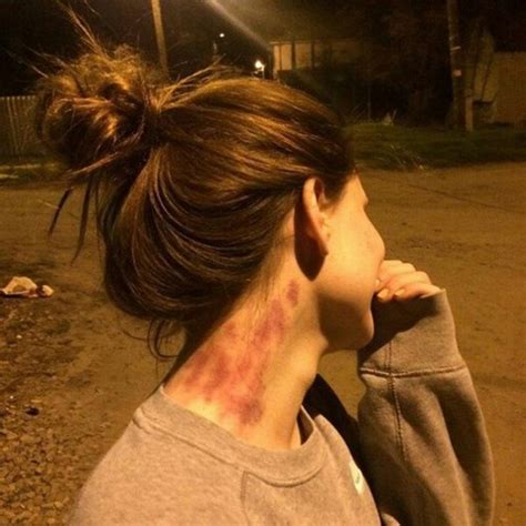 Hickey là gì? Cách thực hiện và xóa bỏ vết bầm do HickeyHickey là gì ...