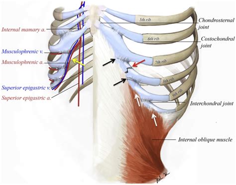 Rib Cartilage Fracture