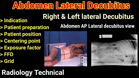 Abdomen Lateral Decubitus # Right & Left lateral decubitus view #Abdomen radiography# Part -3 ...