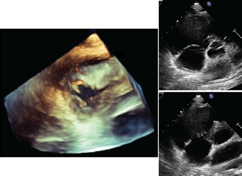 Transthoracic echocardiography of the tricuspid valve in the ...