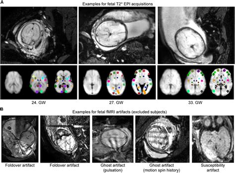 Frontiers | Fetal functional imaging portrays heterogeneous development of emerging human brain ...