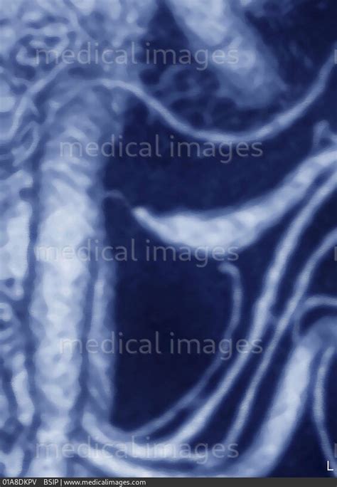 STOCK IMAGE, , 3064108, 01A8DKPV , BSIP - Search Medical & Scientific Stock Photos at ...