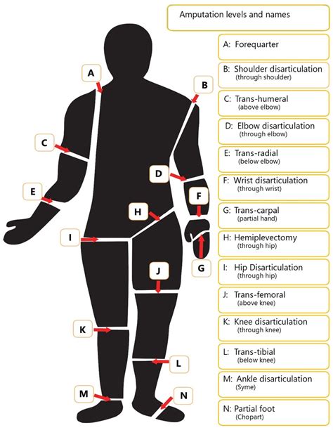 Amputation Levels & Names - Amputees & Families Support Group QLD Inc