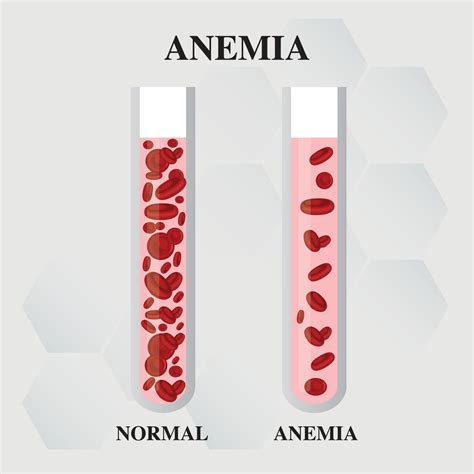 Anemia amount of red blood Iron deficiency anemia difference of Anemia ...