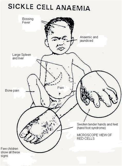 Sickle Cell Disease