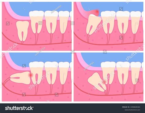 1,358 Wisdom Tooth Extraction Isolated Images, Stock Photos & Vectors | Shutterstock
