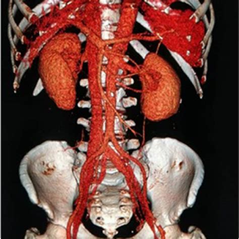 CT axial view showing left iliac fossa traumatic hernia. | Download Scientific Diagram