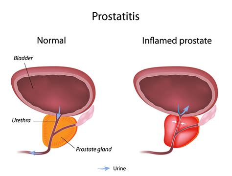 Prostatitis