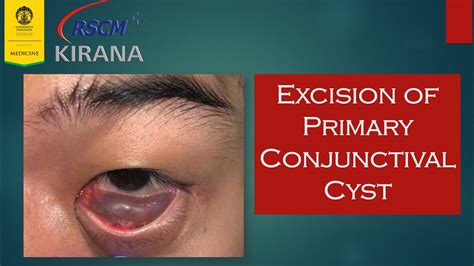 Excision of Primary Conjunctival Cyst - YouTube