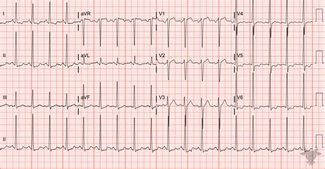 Left Ventricular Hypertrophy | ECG Stampede