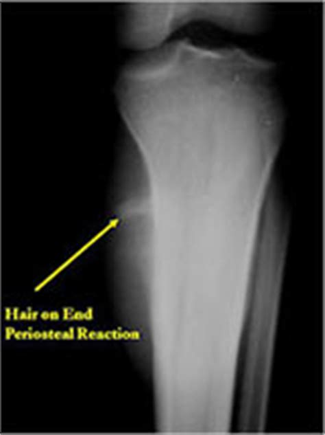 Osteogenic Sarcoma Sunburst