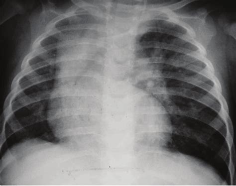 Chest X-ray showing hyperinflation of the left upper lobe, with... | Download Scientific Diagram