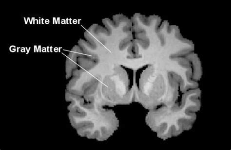 White matter alterations found in brains of college athletes after single football season