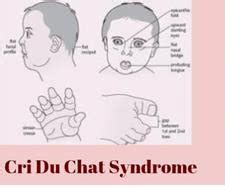 Cri du chat syndrome[54] Cri du chat syndrome is due to a partial... | Download Scientific Diagram