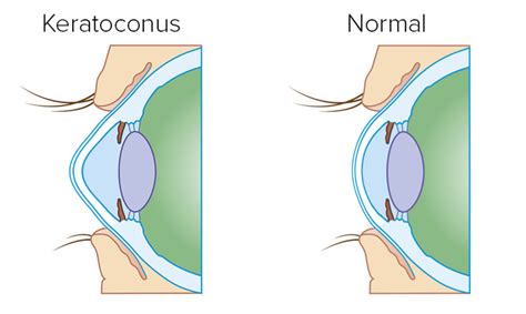 keratoconus-eye-care-apex-zebulon-nc