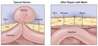 Hiatal Hernia | HealthProducts2