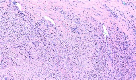 Pathology Outlines - Erythema elevatum diutinum