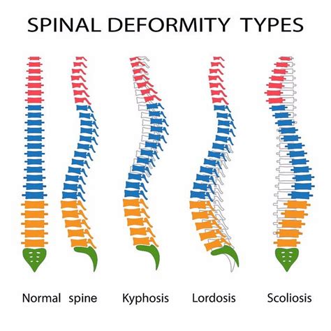 Mild Levoconvex Curvature of the Lumbar Spine - Anna-has-Romero