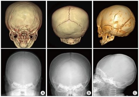 Linear skull fracture in the simple X-ray and 3 dimensional computed... | Download Scientific ...