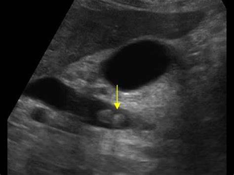 Abdomen and retroperitoneum | 1.2 Gallbladder and bile ducts : Case 1.2 ...